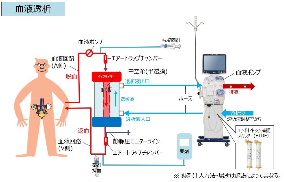 【画像】血液透析